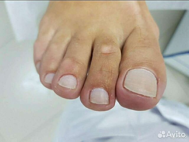 Медицинский педикюр. Подолог. Выезд на дом